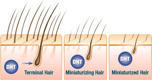 5αリダクターゼ
